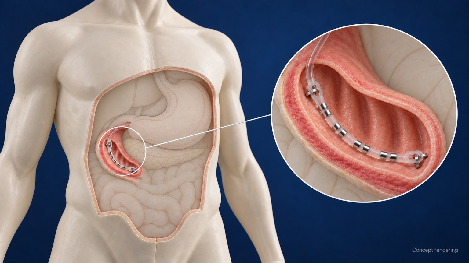 Concept rendering showing Futura Gastroduo in the duodenum within an anatomical torso, with a magnified placement view
