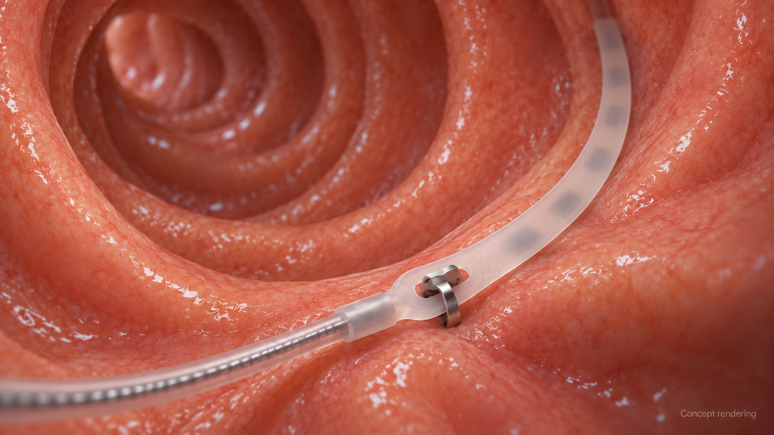 Conceptual close-up of a fixation point securing the soft lead carrier against the intestinal lining