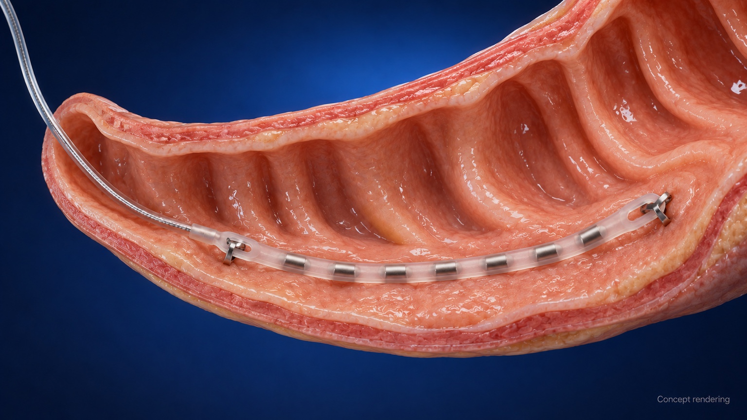 Conceptual cutaway showing the proposed lead positioned along the inner wall of the duodenum